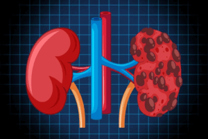Chronic Kidney Disease: A Guide to Understanding and Managing Your Kidney Health