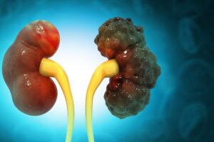 Polycystic Kidney Disease: What to Know About This Silent Disorder