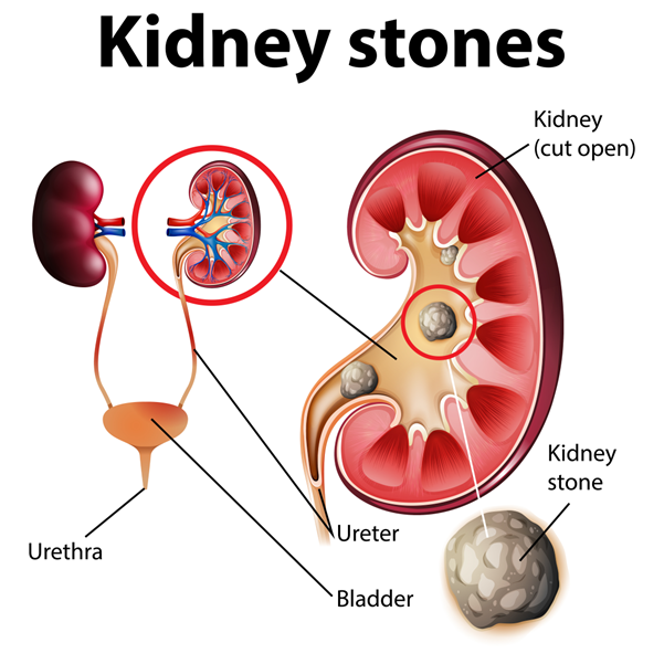 You are currently viewing Coping with Kidney Stones: Causes, Symptoms, and Treatment