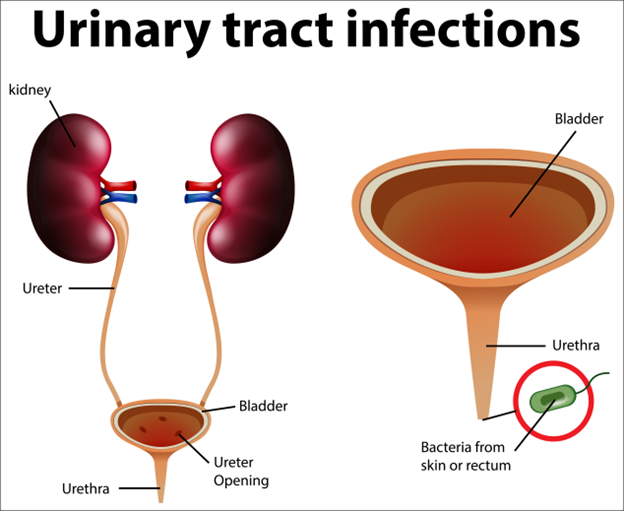You are currently viewing A Closer Look at Chronic Urinary Tract Infection (UTI)