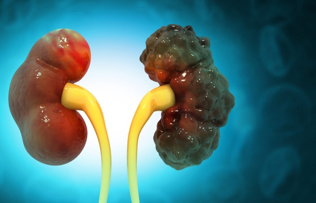 Best kidney clinic in Raichur